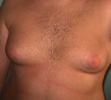 у мужчины женская грудь гинекомастия